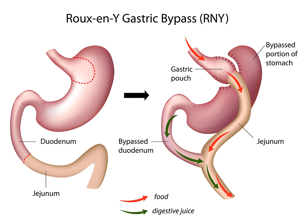 bypass-g-strico-en-y-de-roux-instituto-bari-trico-dr-luis-a-betances